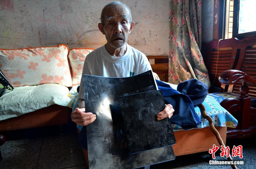쓰촨 94세 노병, 몸 속 총알 60년 후 발견돼