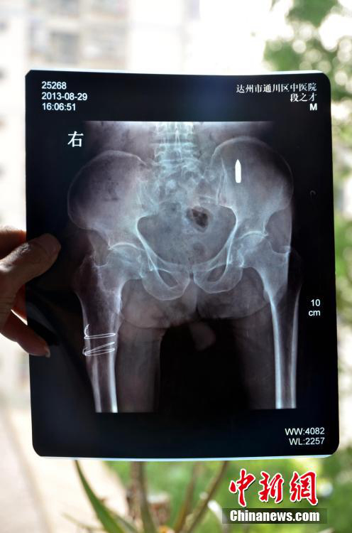 쓰촨 94세 노병, 몸 속 총알 60년 후 발견돼