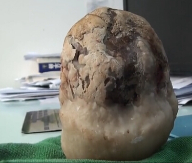 후베이 노인 방광서 1kg 결석, 언뜻 보면 옥석 같기도