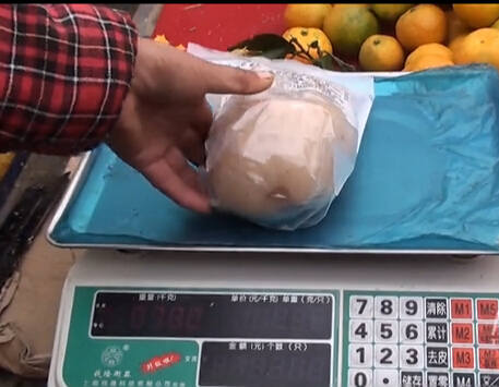 후베이 노인 방광서 1kg 결석, 언뜻 보면 옥석 같기도