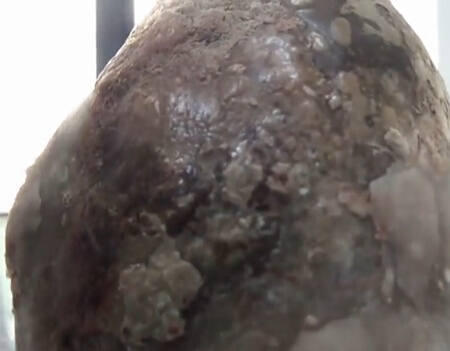 후베이 노인 방광서 1kg 결석, 언뜻 보면 옥석 같기도