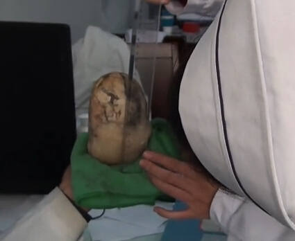 후베이 노인 방광서 1kg 결석, 언뜻 보면 옥석 같기도