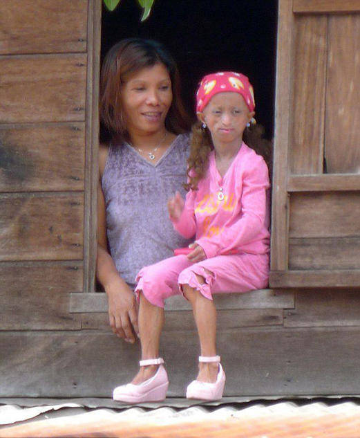 아시아 가장 ‘늙은’ 소녀 사망, 신체 나이는 150세