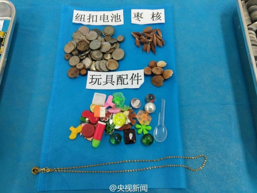 중국 아이들이 실수로 삼킨  물건들, 믿을 수가 없네!