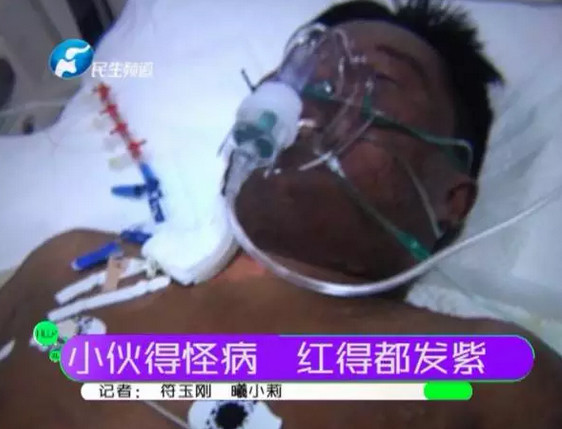 감기 걸려 약 먹은 후 원인불명 질병 걸린 중국인 남성