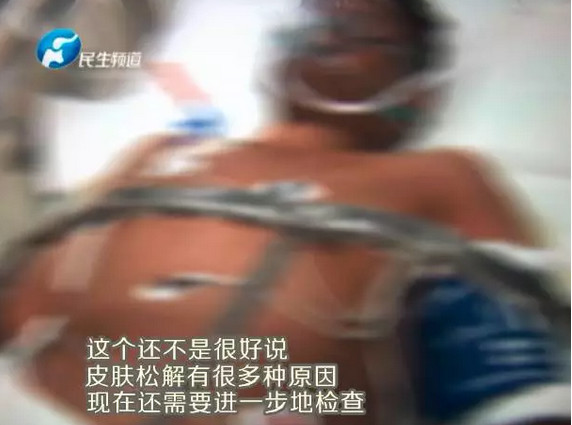 감기 걸려 약 먹은 후 원인불명 질병 걸린 중국인 남성