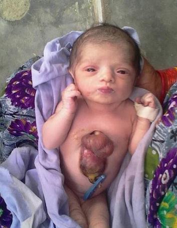 印: 심장이 가슴 밖에 달린 신생아 탄생, 생존확률 50%