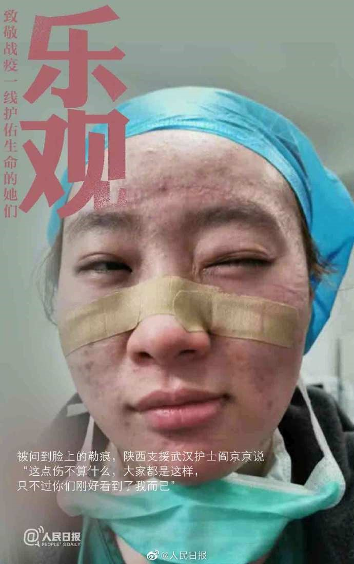 낙관: 얼굴에 난 상처에 대해 묻자 산시(陝西) 출신 옌징징(閻京京) 간호사는 “아무 것도 아니에요. 다들 똑같아요. 저를 막 보셔서 그럴 뿐이에요”라고 말했다.
