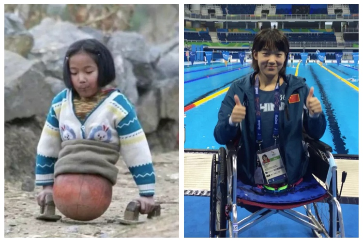 농구공 소녀에서 물속의 날치로…두 다리를 잃은 중국 소녀의 사연