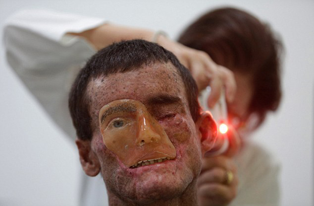 브라질男 피부 유전병 ‘충격’… 태양 노출 시 피부 녹아